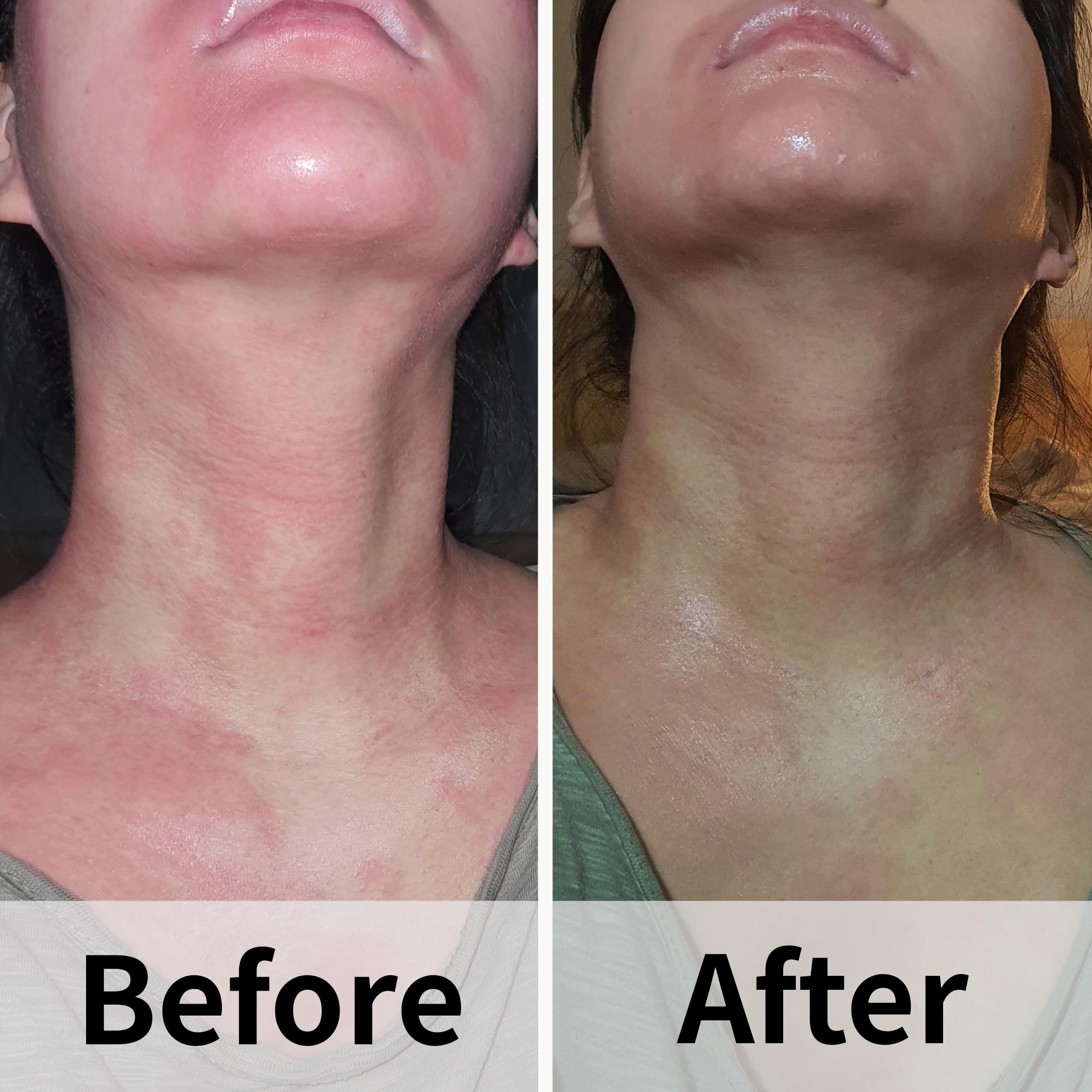 AD SOLUTION Ato Fast Calming Serum for Sensitive & Eczema-Prone Skin Instant Relief from Itch, Redness & Flare-Ups
